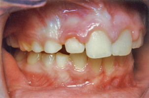 Ορθοδοντική δύο φάσεων - Ορθοδοντικός Δρ. Ζαρμπή