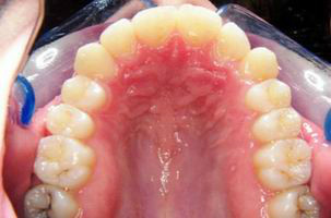 Φυσιολογικό στόμα - Ορθοδοντικός Δρ. Ζαρμπή