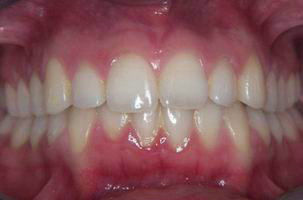 Φυσιολογικό στόμα - Ορθοδοντικός Δρ. Ζαρμπή, διδάκτωρ Πανεπιστημίου